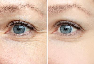 Follow These Steps to Get Rid of Under Eye Wrinkles