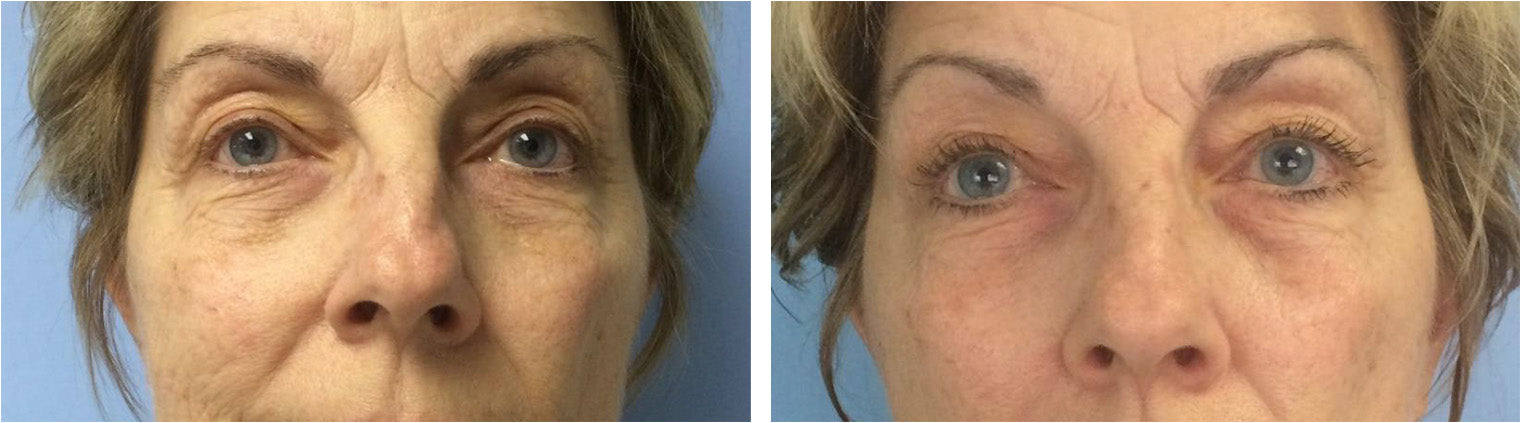 Anti-Aging Eye Wrinkles Before/After